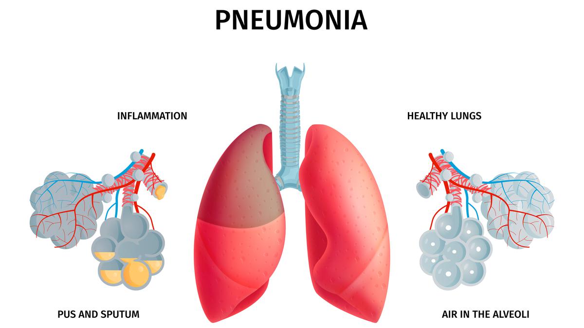 Mengenal Pneumonia, Kerap Disebut Masyarakat dengan Paru-Paru Basah